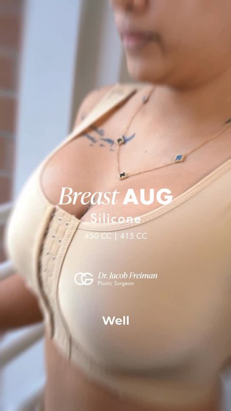 Breast Augmentation Testimonial from a Miami Patient