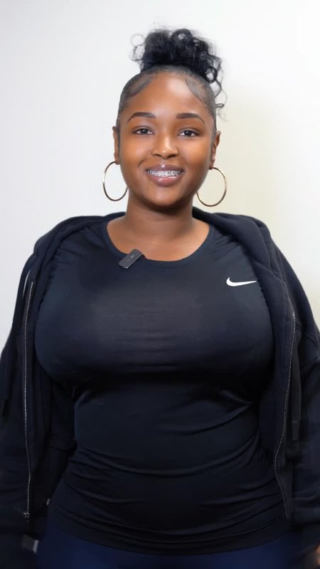 My Results After Breast Reduction at CG Cosmetic