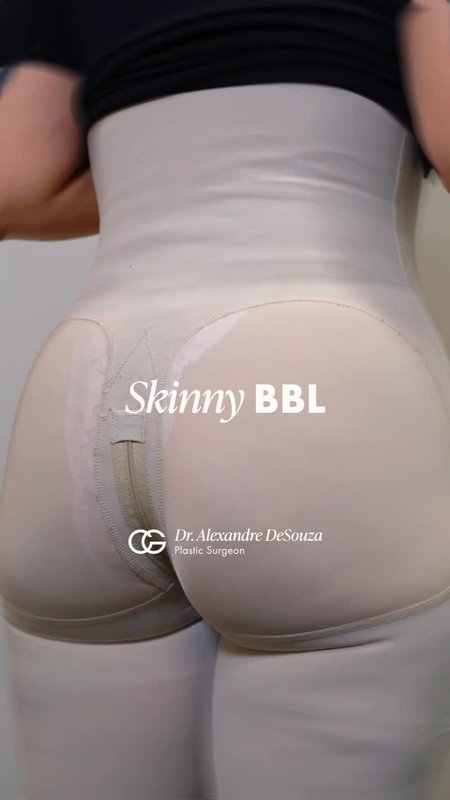 Brazilian Butt Lift (BBL) Outcome, Patient Perspective