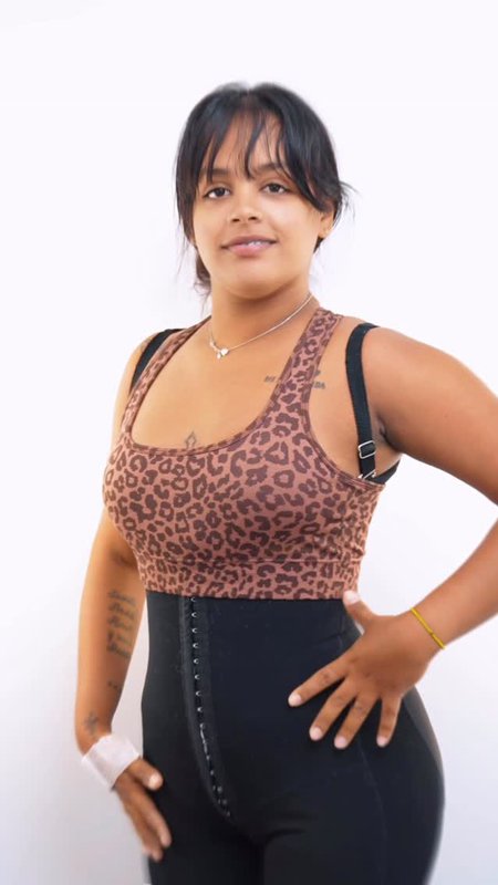 Why I Chose CG Cosmetic for My Brazilian Butt Lift (BBL