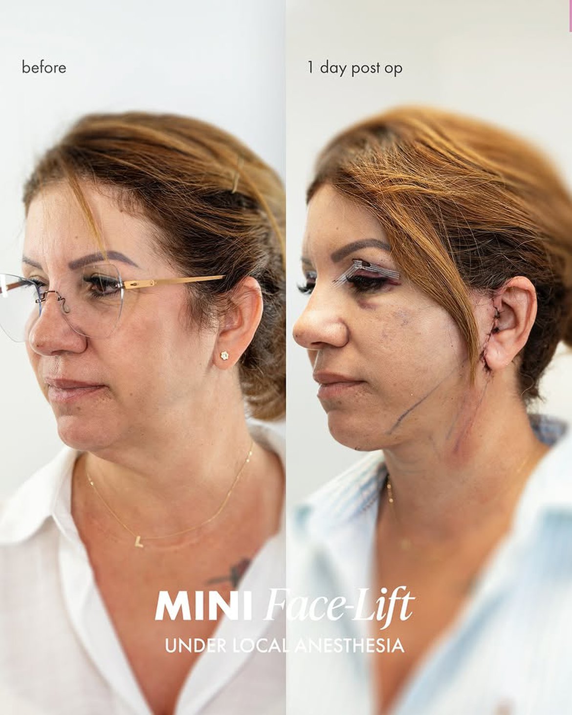 Mini Lift 50 years old woman