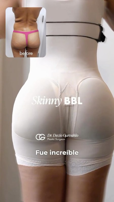 Miami Brazilian Butt Lift (BBL), Patient Testimonial