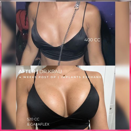 @camicuesta_ 4 weeks post op Breast Implants Ex...